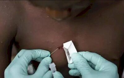 Giải mã căn bệnh đậu mùa khỉ đang lây lan khắp toàn cầu: Liệu có phải đại dịch tiếp theo đe dọa nhân loại?