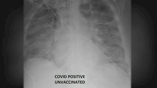 Ảnh chụp phổi của bệnh nhân COVID-19 chưa được tiêm vaccine