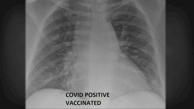 Ảnh chụp phổi của bệnh nhân COVID-19 đã được tiêm vaccine