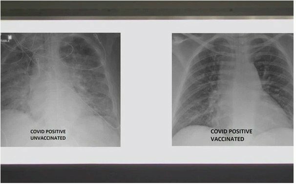 So sánh ảnh chụp phổi của bệnh nhân COVID-19 không tiêm và có tiêm vaccine
